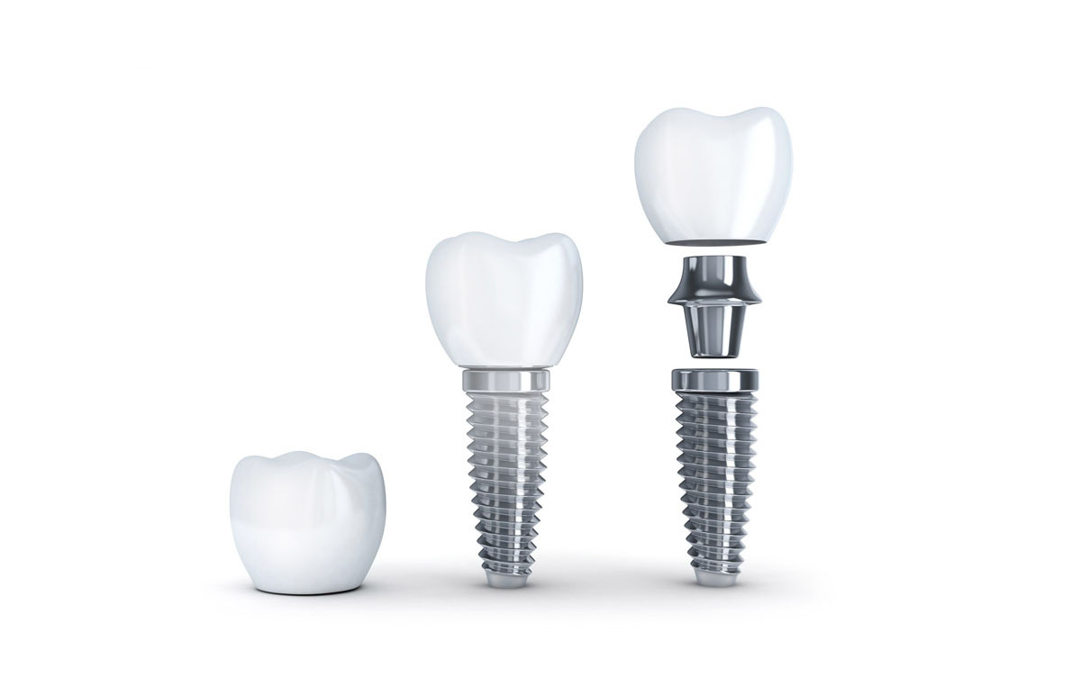 Implanty zębów Stomatologia WAMED Katowice